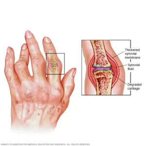 Imagen ilustrativa de una mano con artritis, se utiliza para complementar un blog sobre tratamientos para la artritis